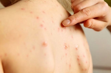 Arizona Part of Second Largest Measles Outbreak in United States Since 2000