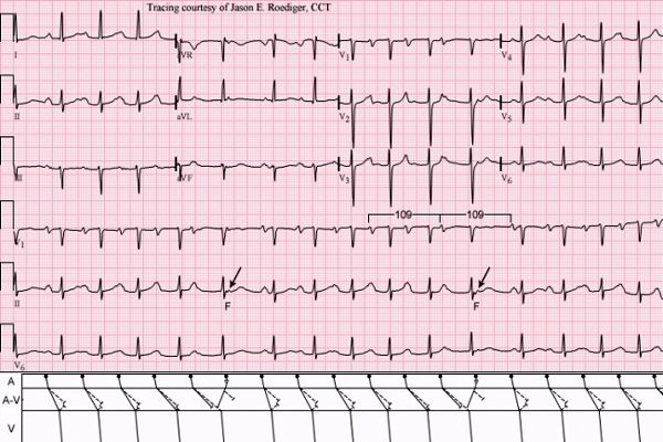 Improvised Drug Therapy for heart health soon},{Improvised Drug Therapy for heart health soon