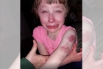 Wisconsin girl, girl, 10 year old special needs child brutally bitten on arm while returning home in school bus, Special needs