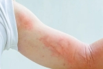 symptoms, symptoms, dermatological symptoms could be a sign for covid 19 infection, Medical professionals