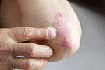 Skin disorders news, Skin disorders health issues, five common skin disorders and their symptoms, Gi disorders