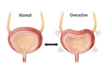 Overactive Bladder latest, Overactive Bladder signs, here are some warning signs of an overactive bladder, Bsu