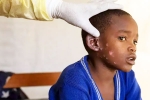 Monkeypox Outbreak new, Mpox, is monkeypox outbreak coming to india, Monkeypox