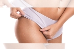 white stretch marks before and after, white stretch marks weight loss, difference between red and white stretch marks explained and it s natural to have them, Stretch marks