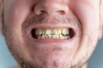 Nicotine stains breaking, Nicotine stains, are nicotine stains on your teeth irreversible, Teeth