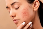 skin care products, acne, 10 ways to get rid of pimples at home, Toxins