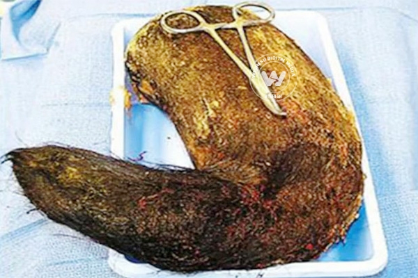Huge ball of hair removed from a girl's gut